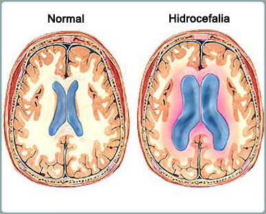 Hidrocefalia.