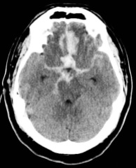 Hemorragia cerebral consequente a rompimento de aneurisma (hemorragia subaracnoide).